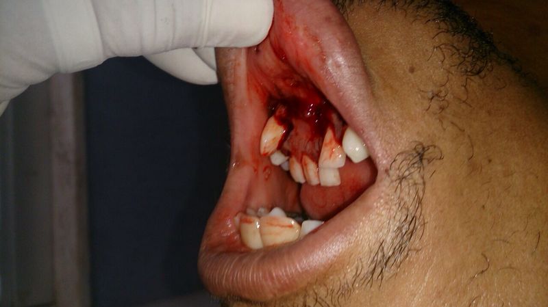 alan-patrick-ufc-broken-jaw-2