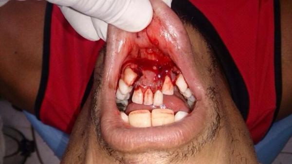 alan-patrick-ufc-broken-jaw